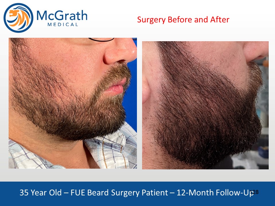 Beard & Facial Hair Transplants McGrath Medical