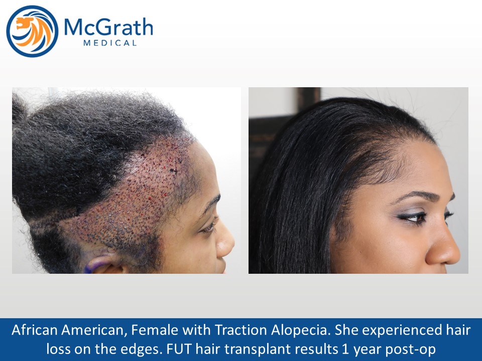 female fue hair transplant before and after Jetta Mccullough