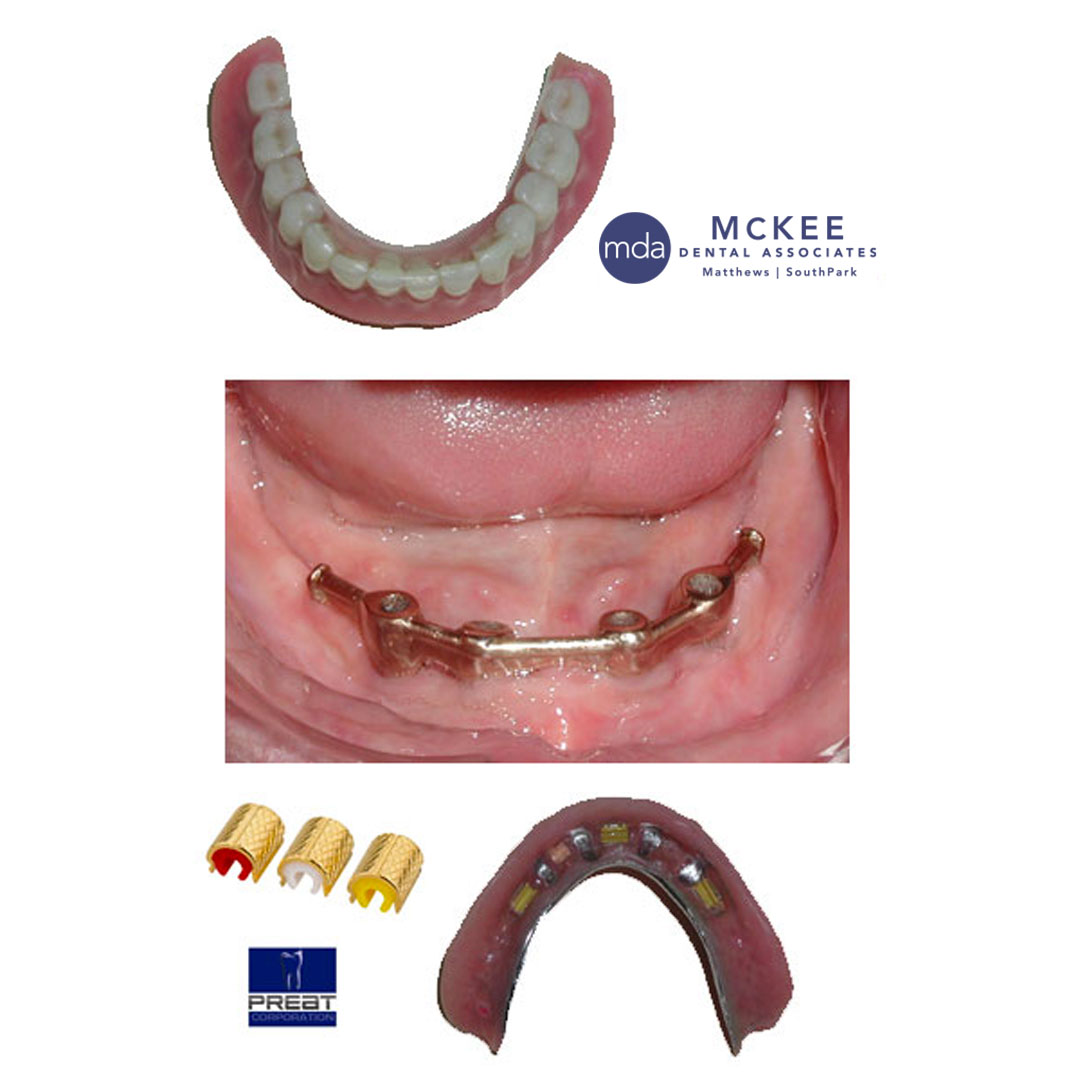 Hader bar When My Denture is Loose