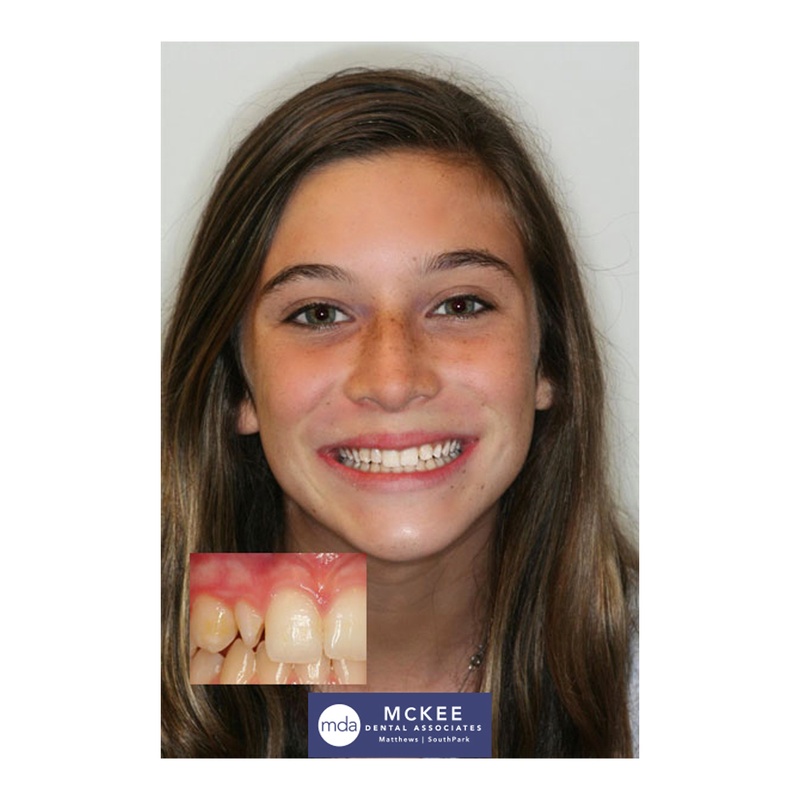 Fixing a Peg Lateral Tooth McKee Dental Associates