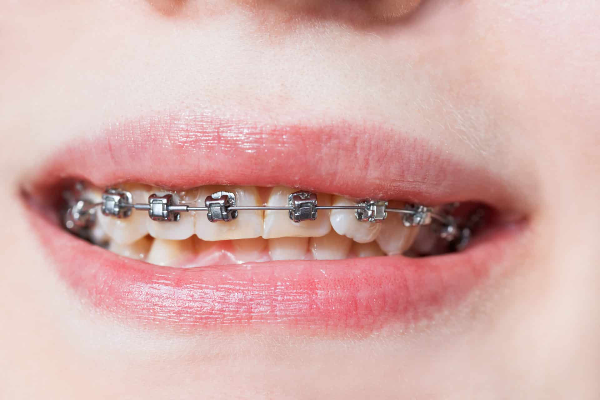 Types of Braces Mary Cay Koen Orthodontics Goodlettsville, TN