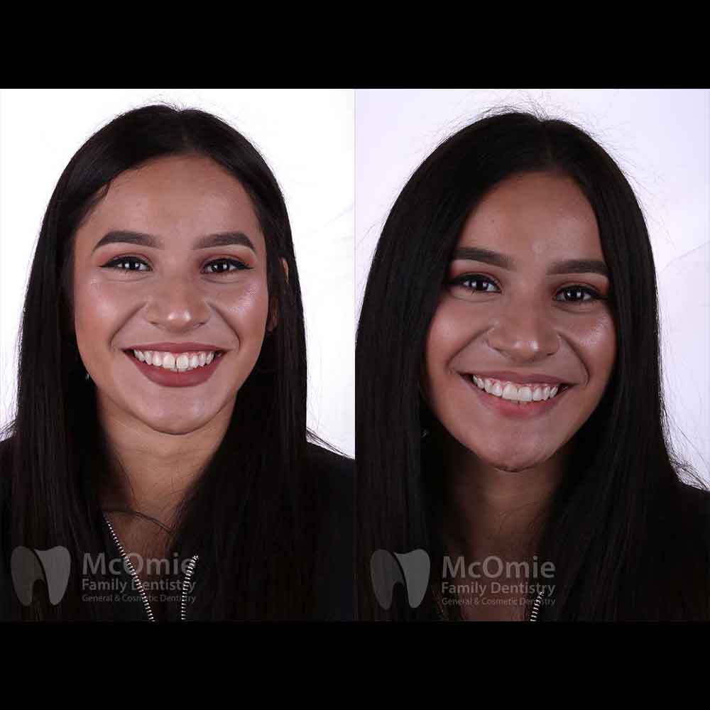 Before And After Teeth Bonding
