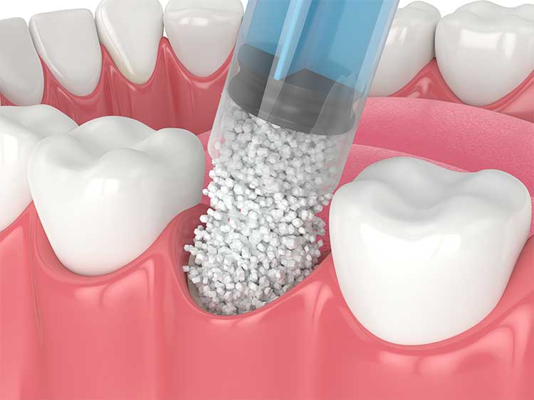 Bone Grafting for Dental Implants Chattanooga, TN Family Dentistry