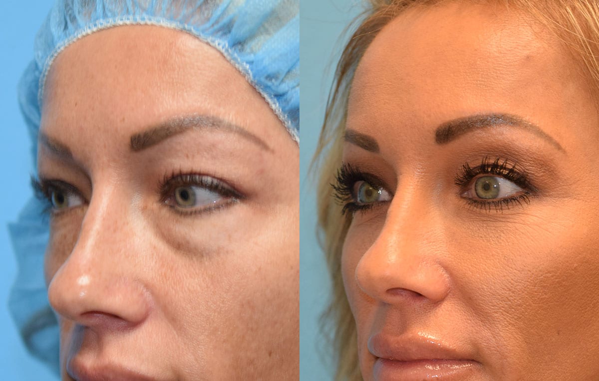 Cosmetic Procedures Eye Bags IUCN Water