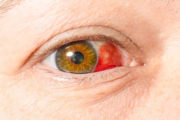 Red Eyes | Mcshaw Optometrists