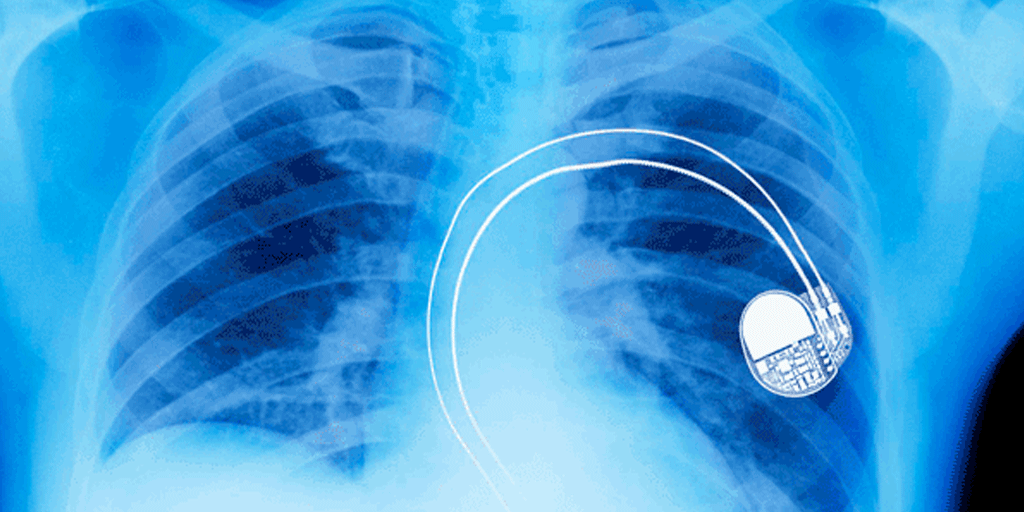 FDA Recalls Nearly Half a Million Pacemakers Over Hacking Fears