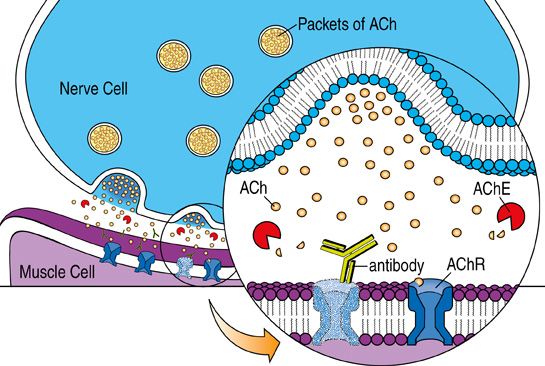 Causes/Inheritance Myasthenia Gravis MDA