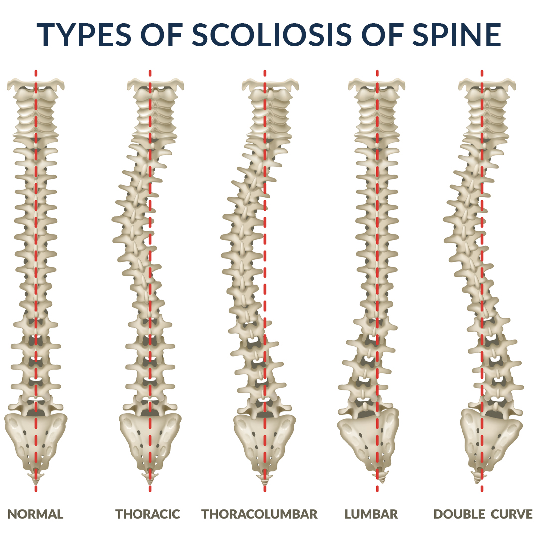 All About Scoliosis, Causes, Signs and Treatments