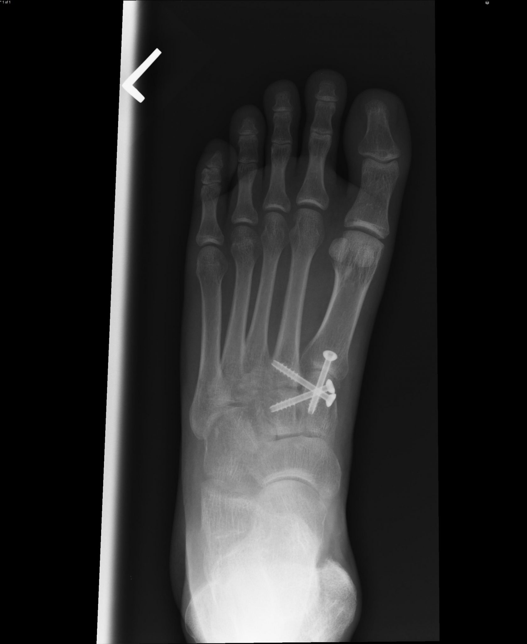 Athletic Injuries of the Foot and Ankle Healthcare and Medical News for Atlanta Physicians
