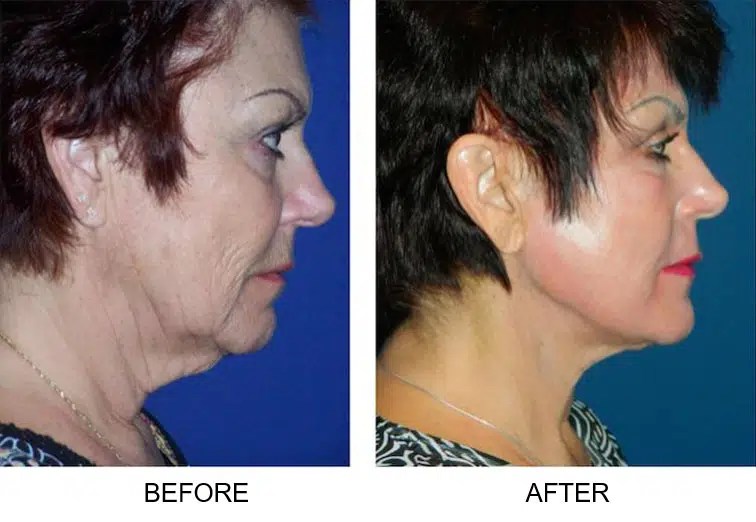 Case 30 Facelift & Laser Maryland Plastic Surgery