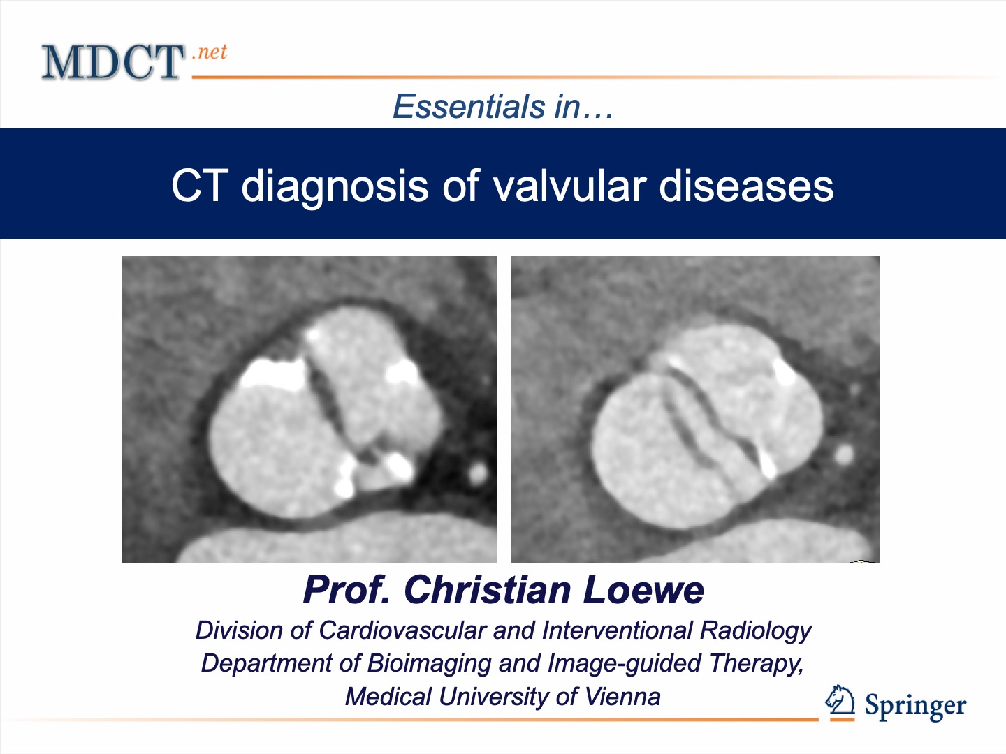 CT diagnosis of valvular diseases