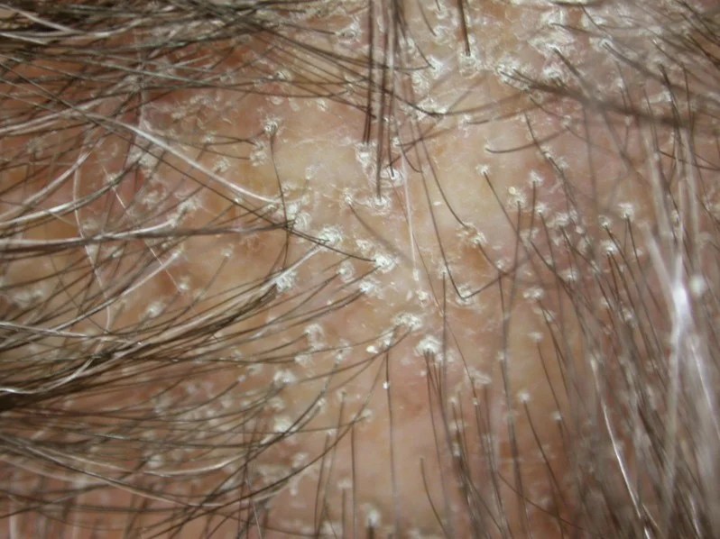 Lichen Planopilaris Pictures, Causes, Treatment, Diagnosis