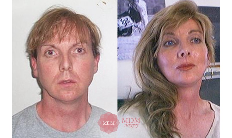 Facial Feminization Procedures / Procedimientos de Feminización Facial