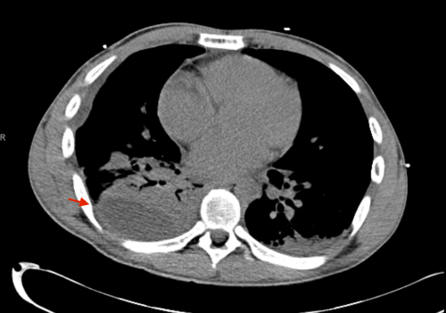Pleural Effusion-Parapneumonic | MD Nexus
