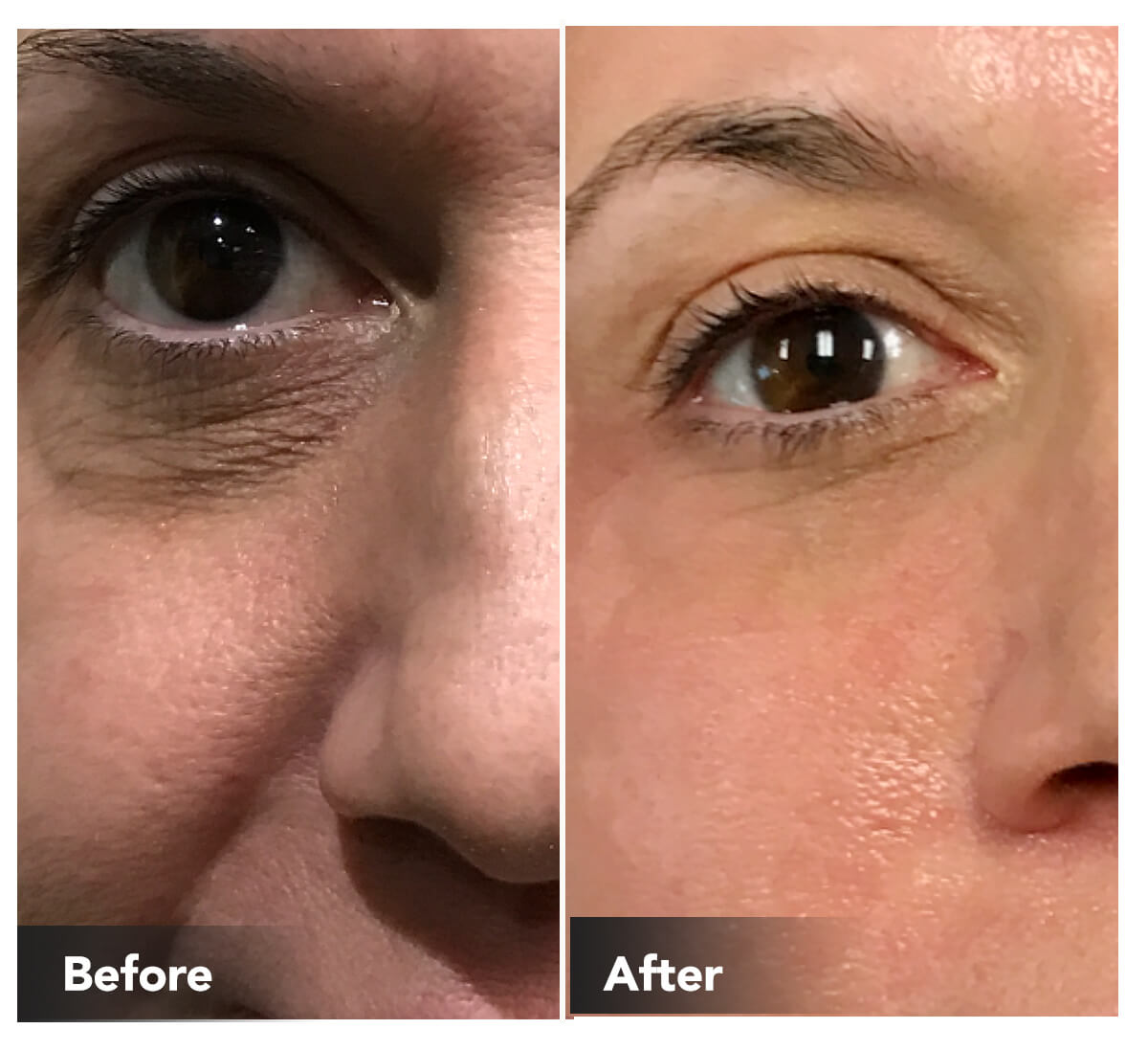 Treating Your Delicate Eye Area with MicroNeedling