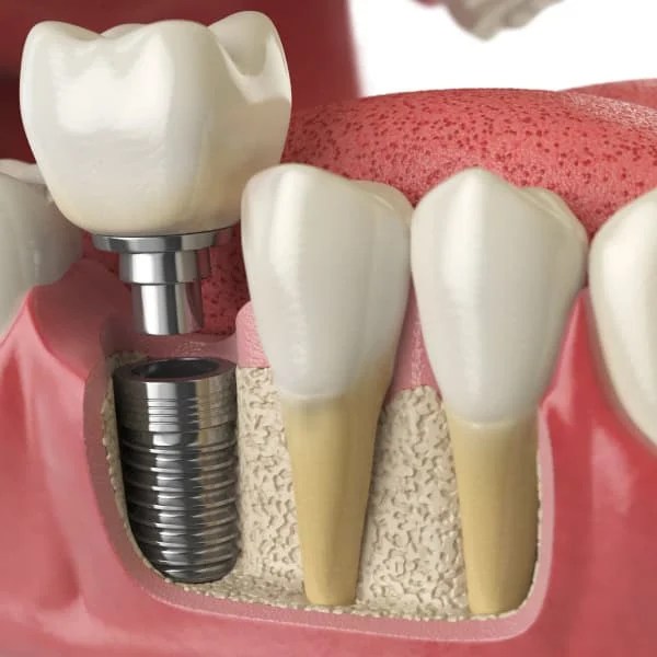 Titanium Dental Implants, MD Periodontics of Los Angeles