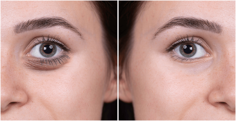 Get A Refreshed And Revitalised Look With These Tear Trough Fillers