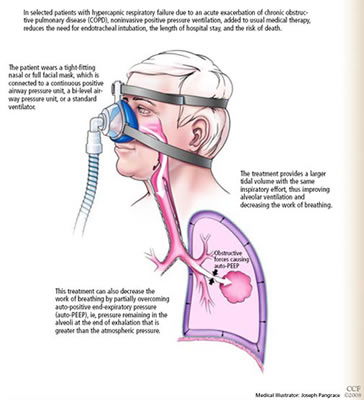The Mechanics Mechanical Ventilation