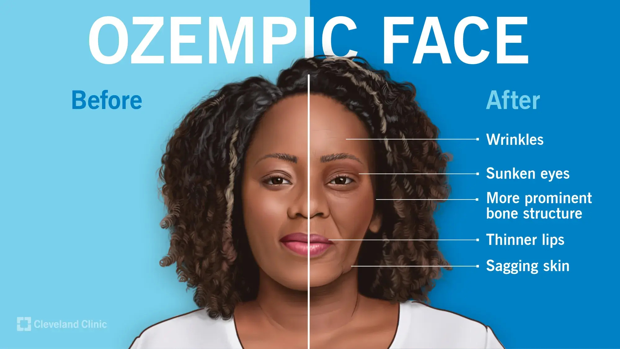 Ozempic What is it? Mech Physio