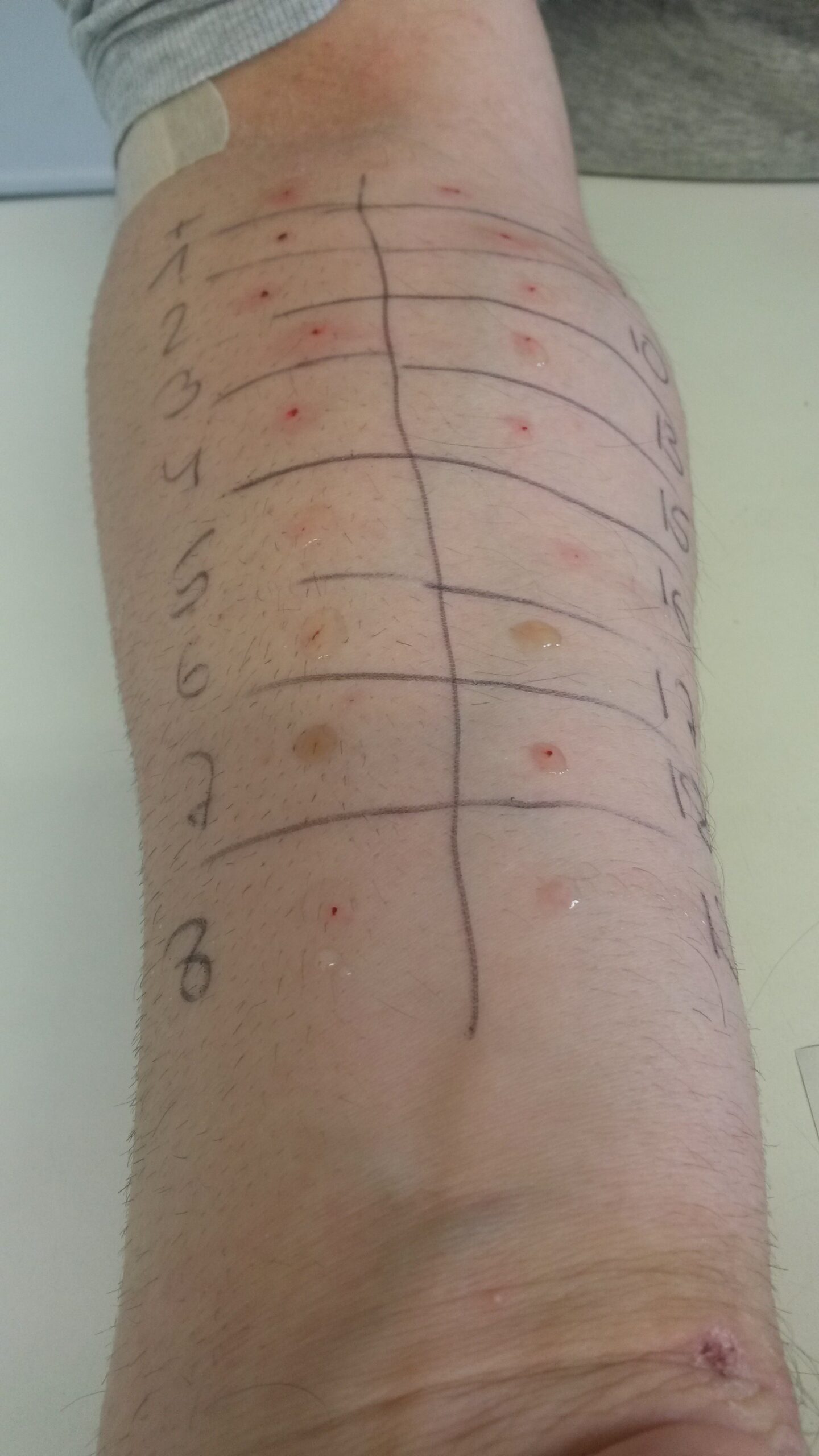 How Does Allergy Testing Work? HealthWise Family Care Center