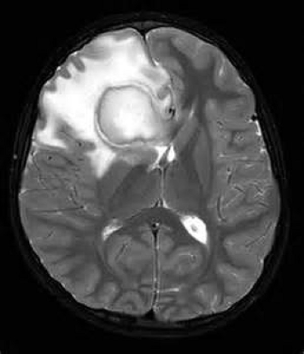 Абсцесс мозга