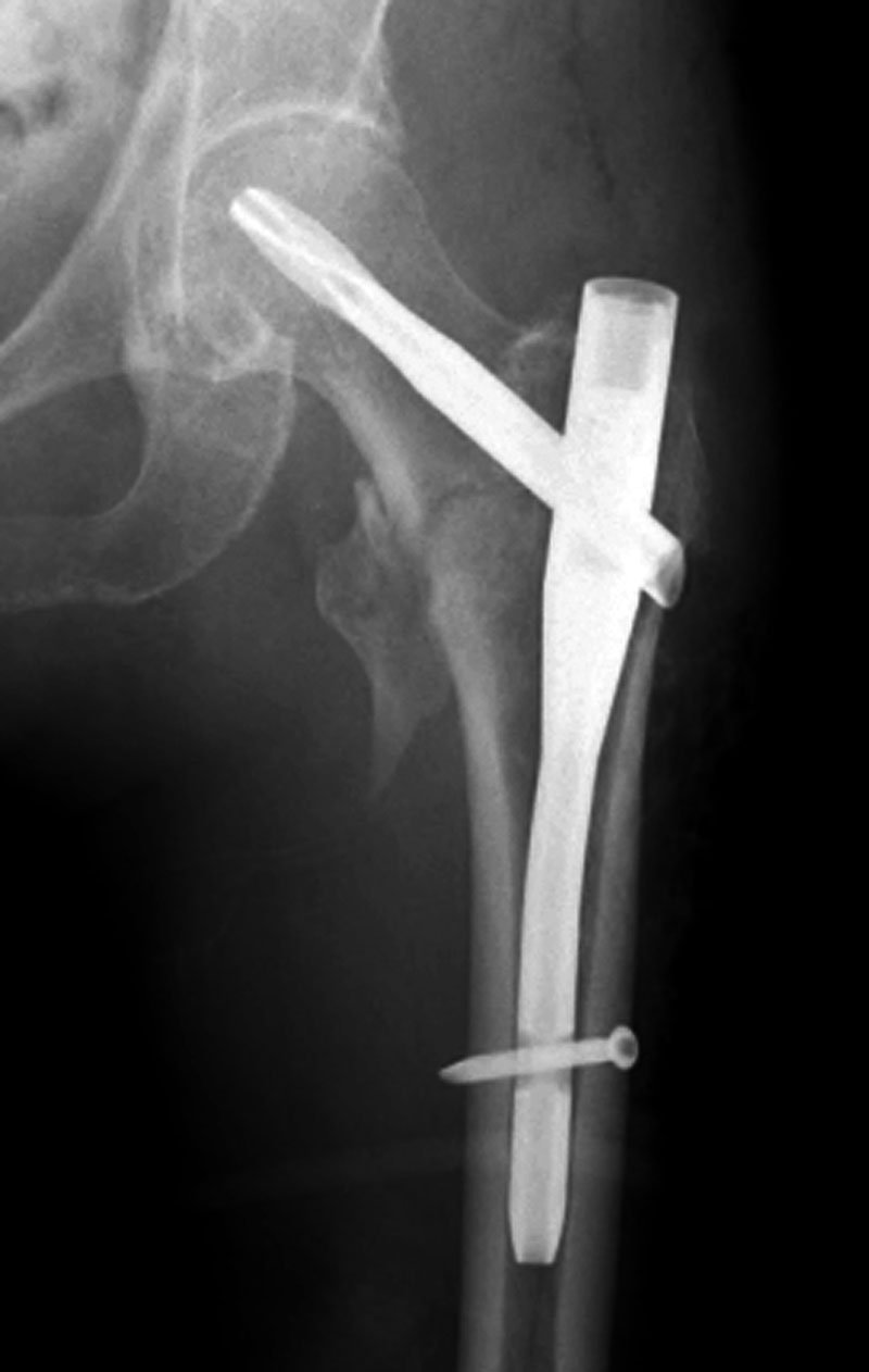 Imaging Guide To Orthopedic Devices An Introduction Images and Photos
