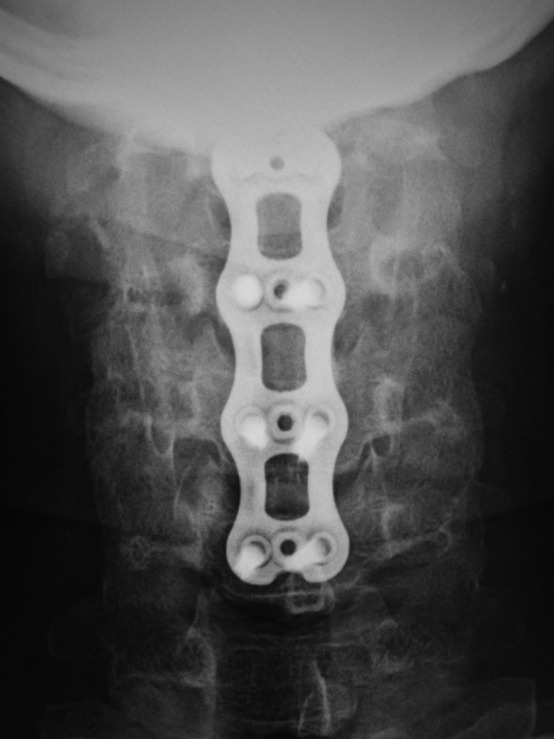 Medical Devices of the Neck and Spine an imaging guide