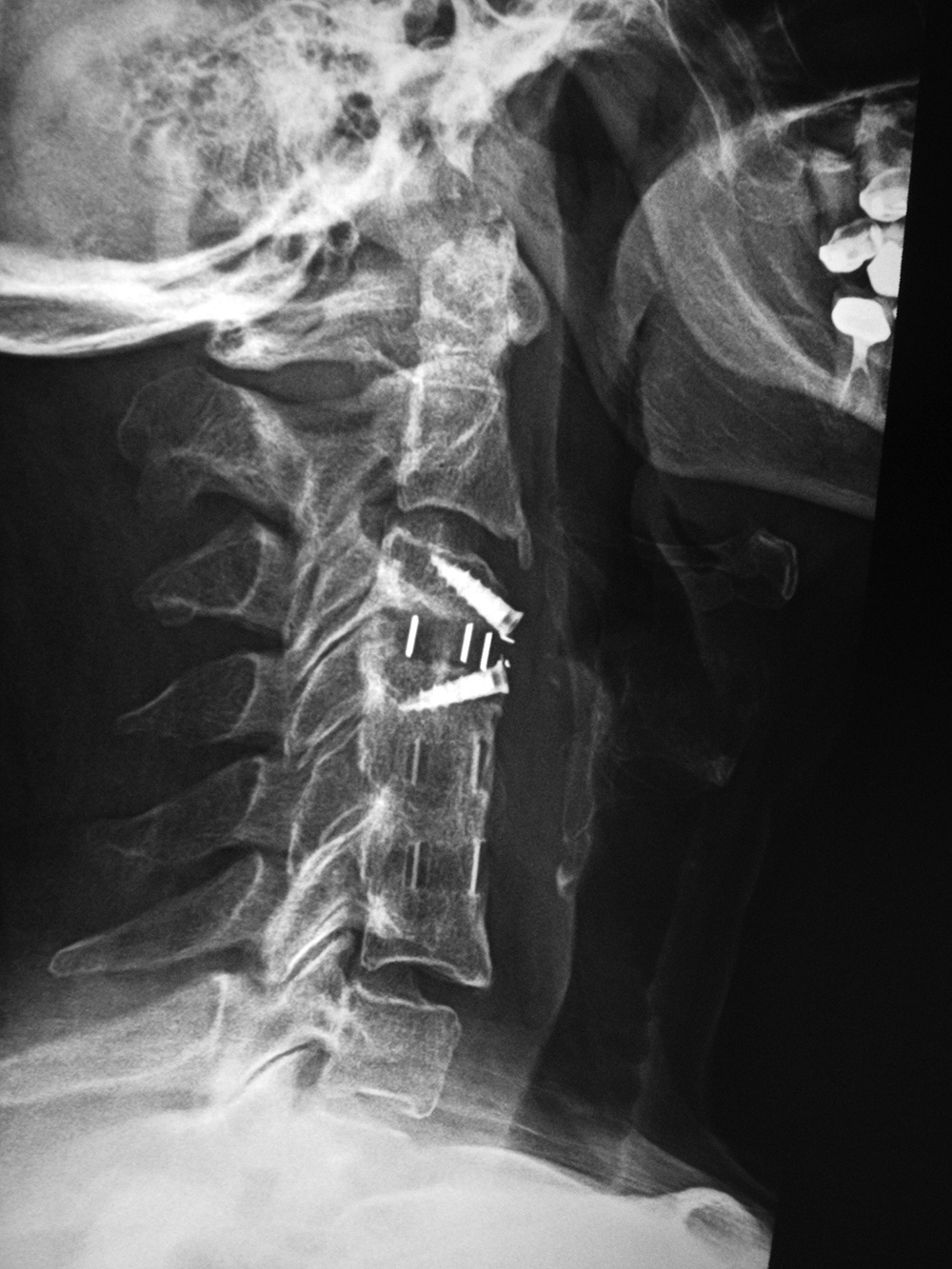 Medical Devices of the Neck and Spine an imaging guide
