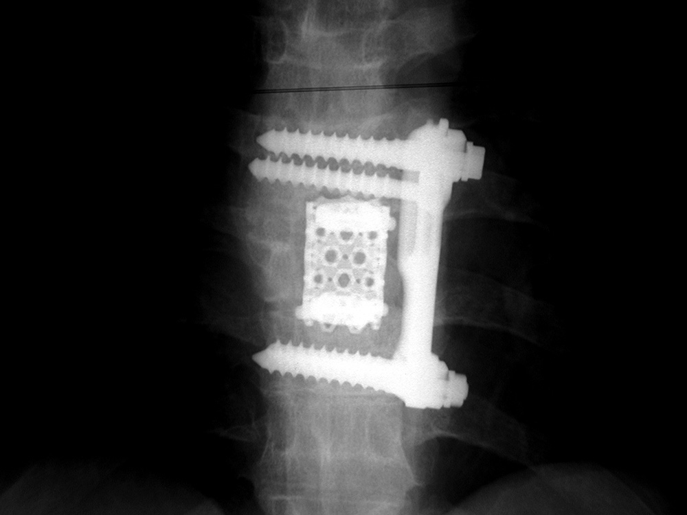 Spinal prothesis brantigan cages