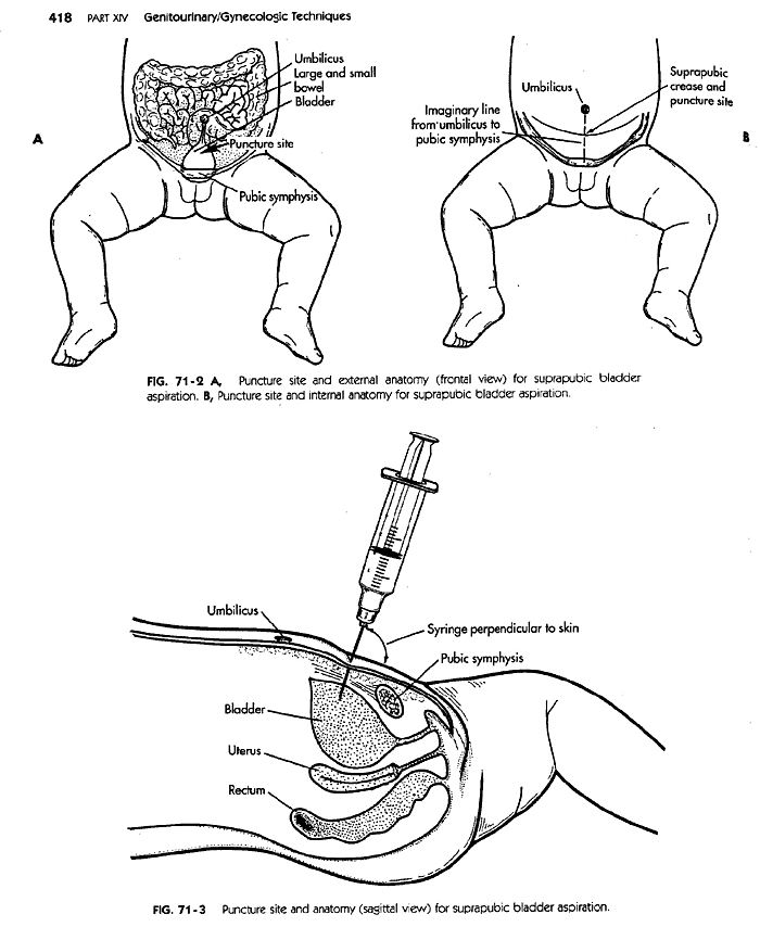 Urinary Tract Infection (UTI) : Etiopathogenesis and Lab Diagnosis