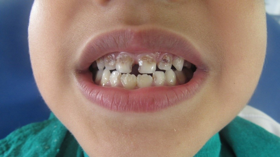 Tooth Decay in ChildrenThe unanswered truth Medchrome