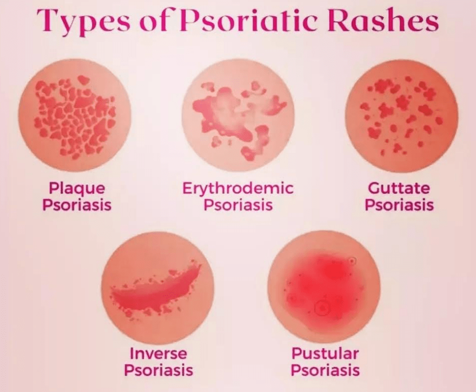 Psoriasis Médecine Intégrée