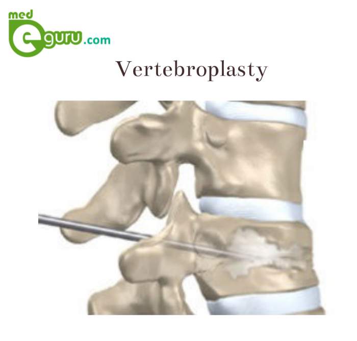 Vertebroplasty Procedures and Risks An Overview MedeguruMed E Guru