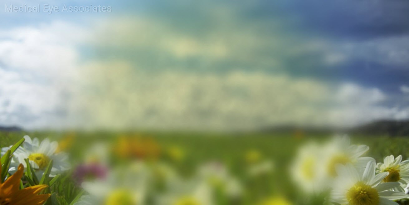 Symptoms of Cataract Medical Eye Associates Symptoms of Cataract Medical Eye Associates