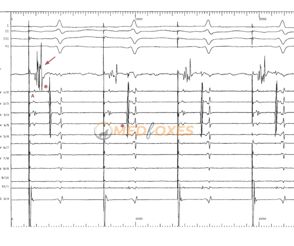 Atrial Fibrillation, Pulmonary Vein Mapping Techniques MedFoxes