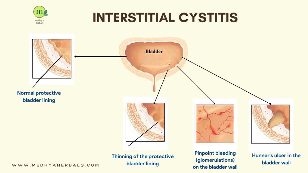 Interstitial Cystitis Treatment The Best Ayurvedic Remedies