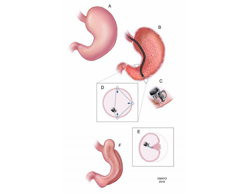 Study Endoscopic Bariatric Procedure Successful in Trials Medical