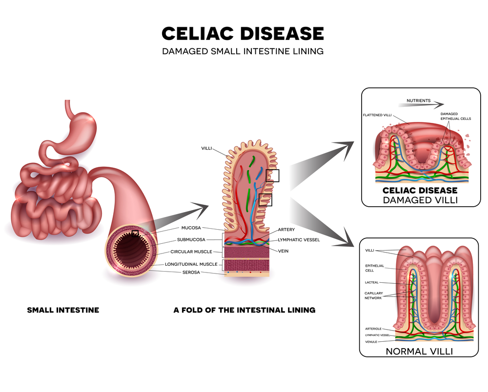 Intestinal Damage Unavoidable for Children with Celiac Research
