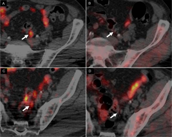 Novel PET Imaging Agent Targets Copper in Tumors, Detects Prostate Cancer Recurrence Early