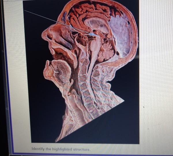 Identify the highlighted region of the thyroid gland.