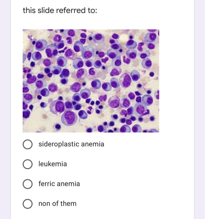 Solved this slide referred to sideroplastic anemia leukemia