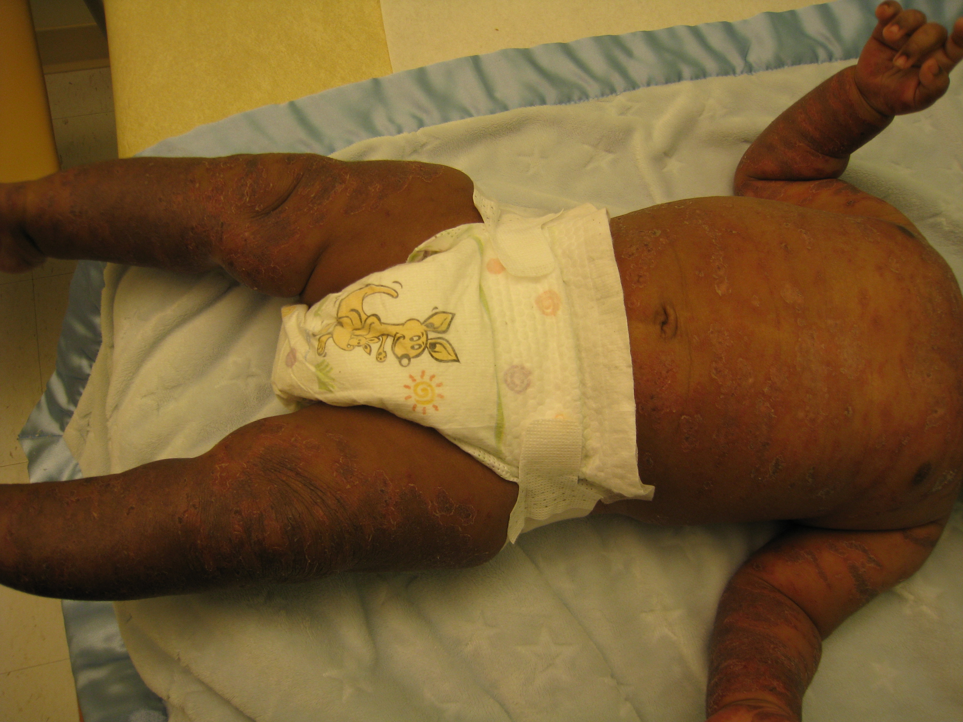 Severe eczema The Clinical Advisor