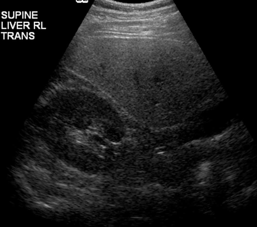 Elevated liver enzymes The Clinical Advisor