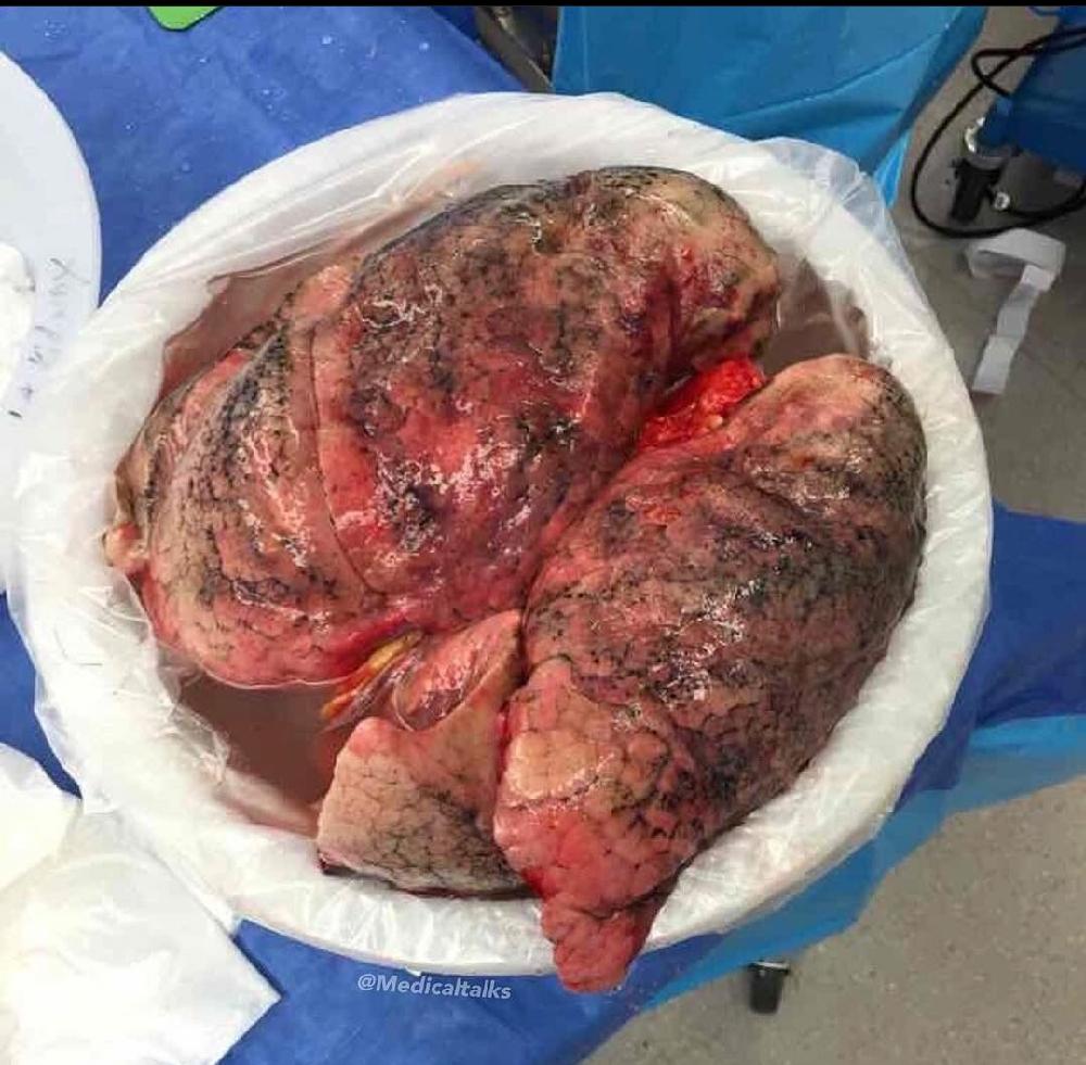 Smoker's lungs