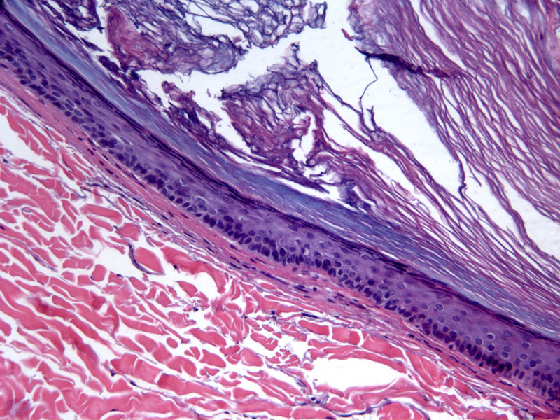Epidermal (infundibular) cysts