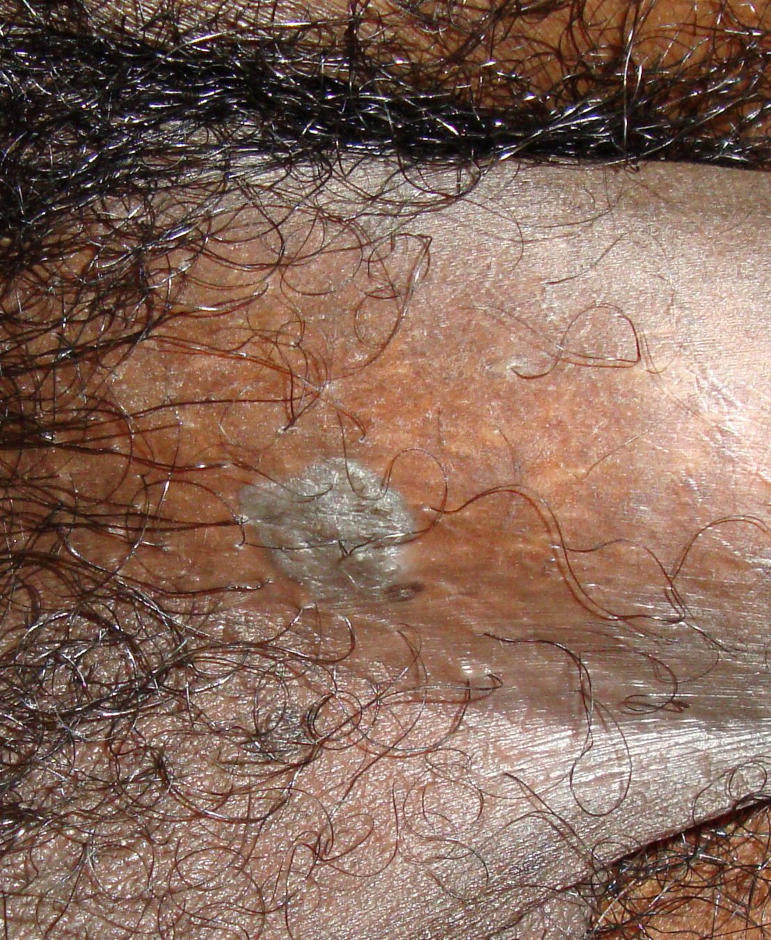 Condyloma acuminatum (Genital warts)