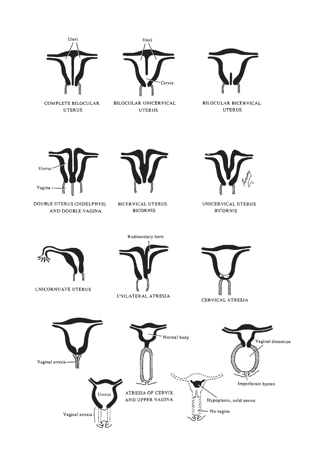 Chapter 110. Uterovaginal Malformations of The Female Review of