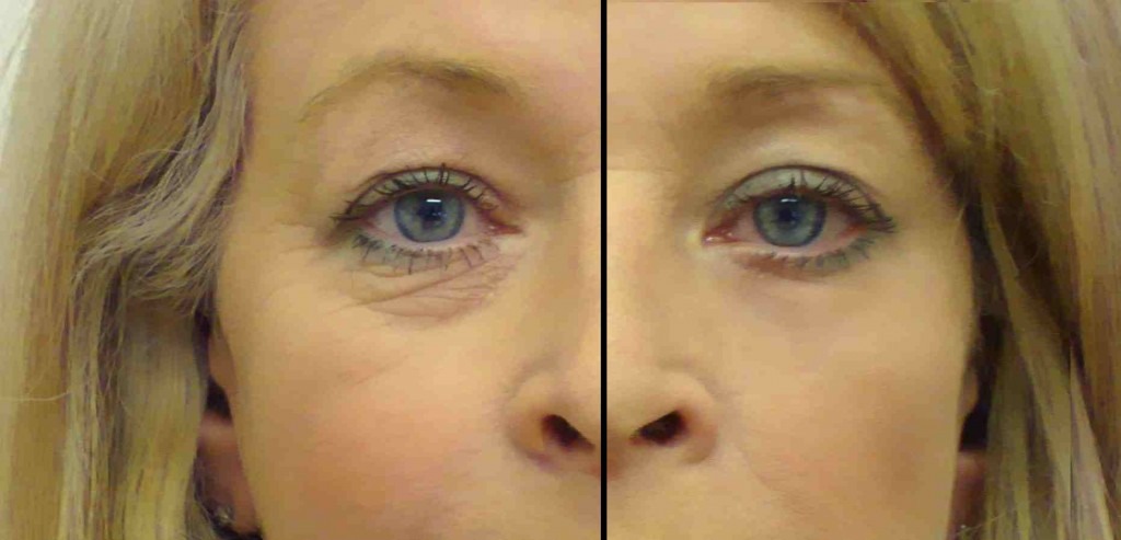 Use Hemorrhoid Cream For Bags Under The Eye At Night. Musely