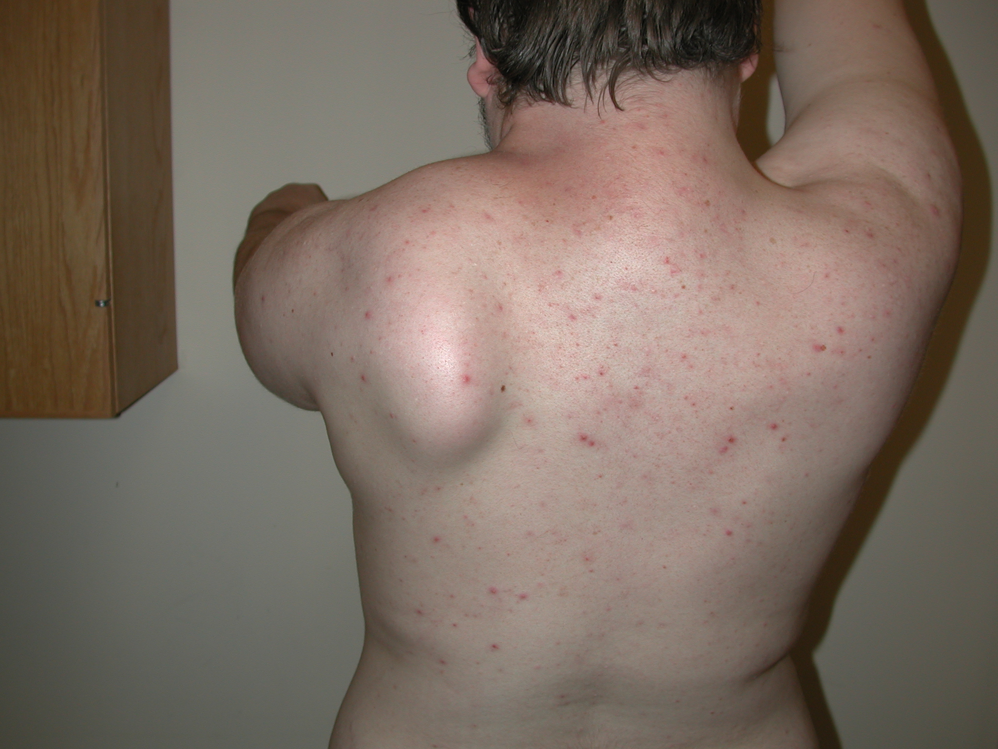 Evaluation and Management of Scapular Winging due to long thoracic