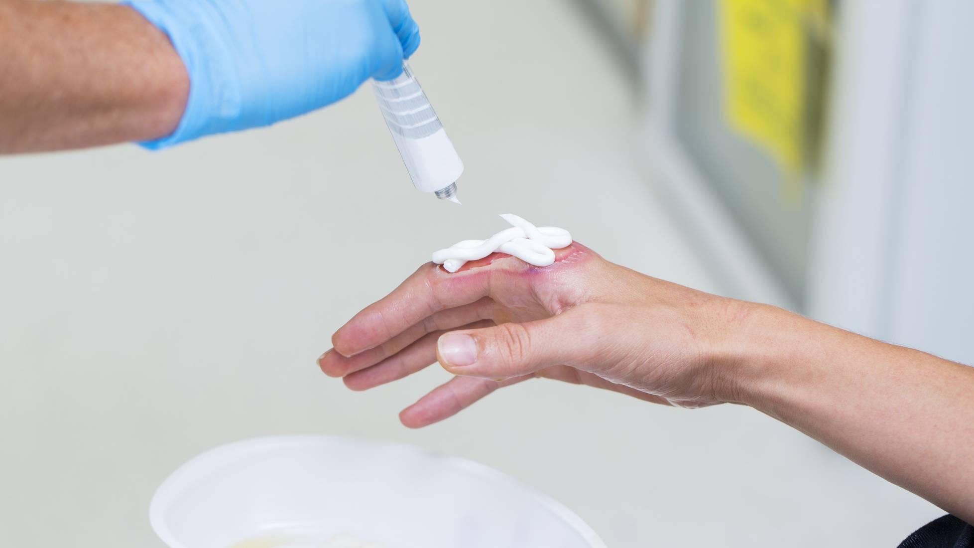 New Burn Nursing Specialty Certification Expected by 2023